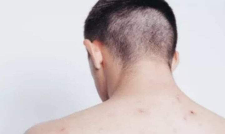 تعرف على أسباب وعلاج حبوب الظهر  