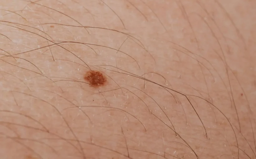 دراسة أسترالية تتوقع انخفاض معدل الإصابة بسرطان الجلد بين الأطفال