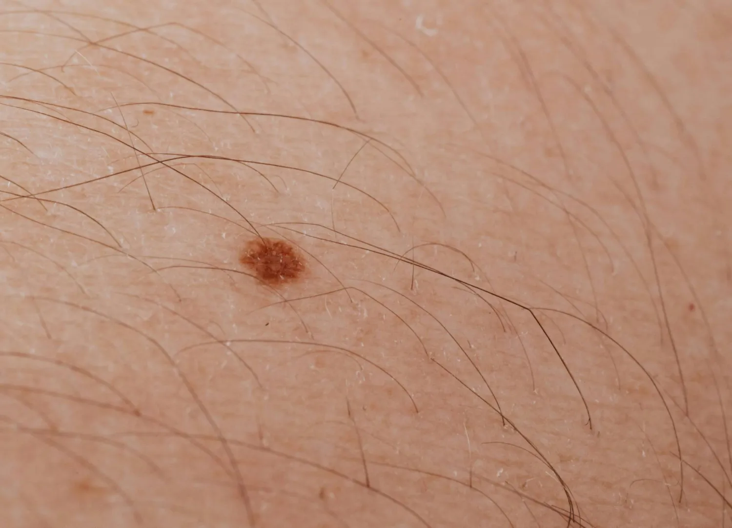 دراسة أسترالية تتوقع انخفاض معدل الإصابة بسرطان الجلد بين الأطفال