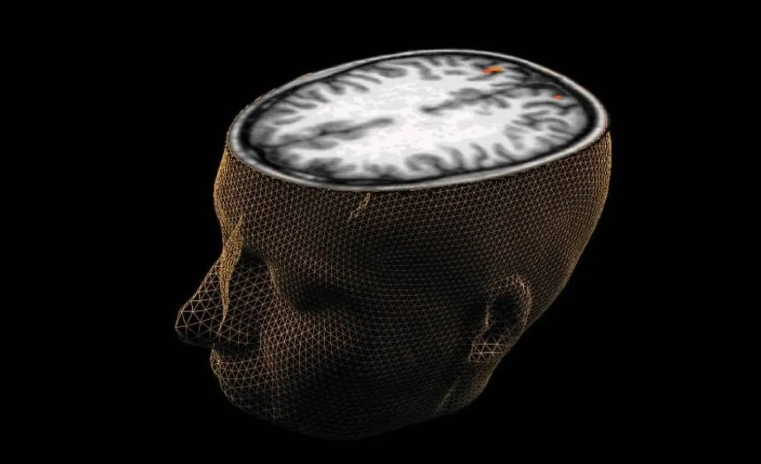 مؤشر حيوي جديد يفتح الباب لتحسين علاج الفصام